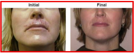 blisterol supplement